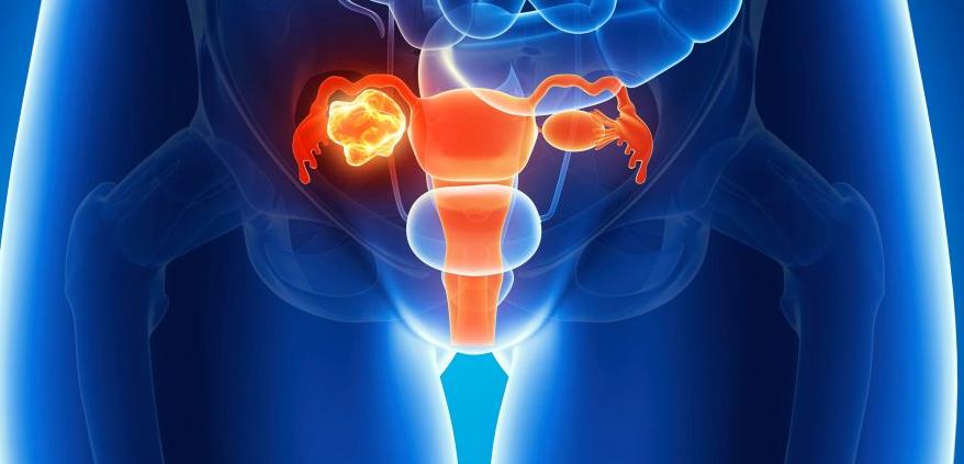 Kanceri Ovarian. Një sëmundje vdekjeprurëse për femrat 2 78 1