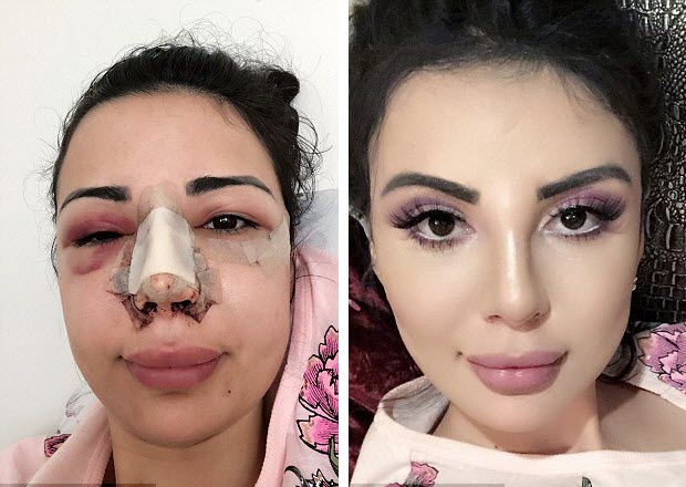Do të jetë si Kim Kardashian, vajza heq 8 brinjë dhe shpenzon gjysmë milion paund me ndërhyrje kirurgjikale 6 Kim 5 3