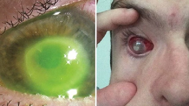 Vendosi lentet e kontaktit, gruaja humb shikimin në syrin e majtë 1563793006 Contactlenssideaffect793229
