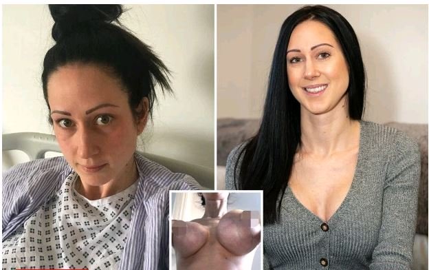 Foto/ I shpërtheu gjoksi, pasi e zmadhoi me ndërhyrje kirurgjikale: Mendova se po vdisja Gjoksi