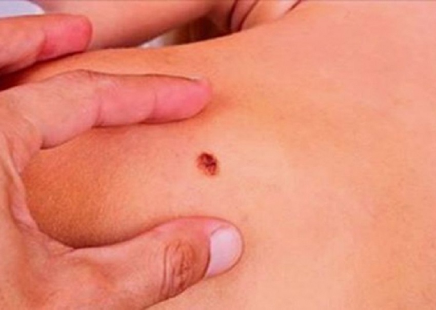 Aplikacioni që mund të shpëtojë jetën tuaj duke diagnostikuar melanomat e lëkurës aplik1