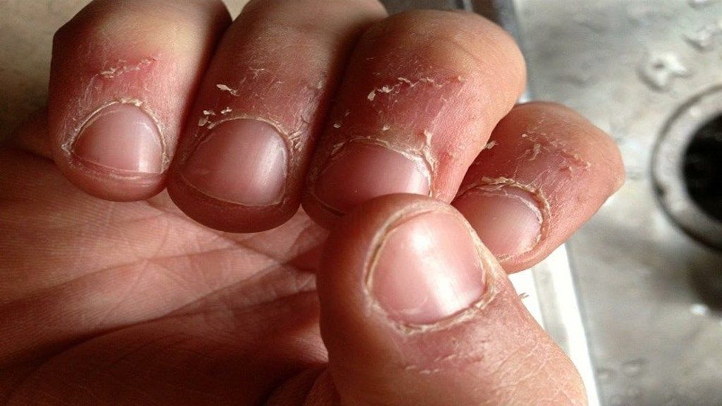 Çfarë janë spicat e thonjve, nga krijohen dhe si kurohen ato? (Foto) 2 1 8