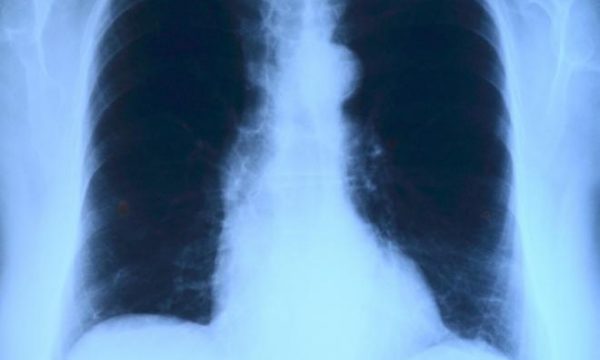 Shenjat e para të sëmundjeve të mushkërive të cilat çdo njeri duhet t’i dijë lung x ray 600x360 1