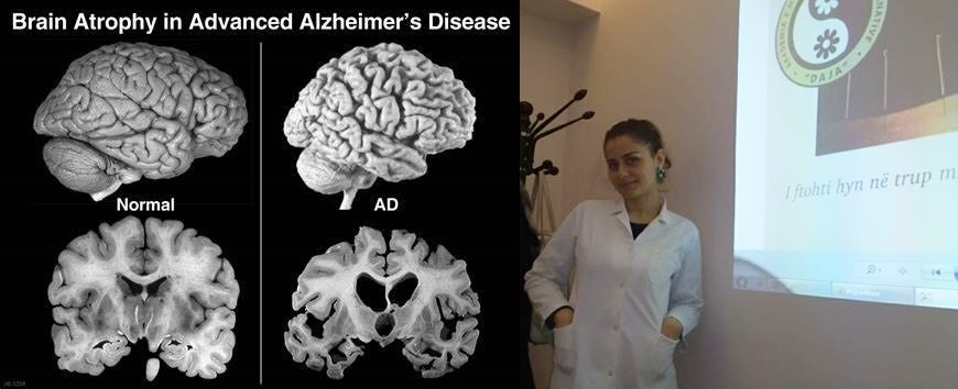 Si ndikojnë qelizat mieloide në shkaktimin e sëmundjes së Alzheimerit (AD) Hiljana Biba
