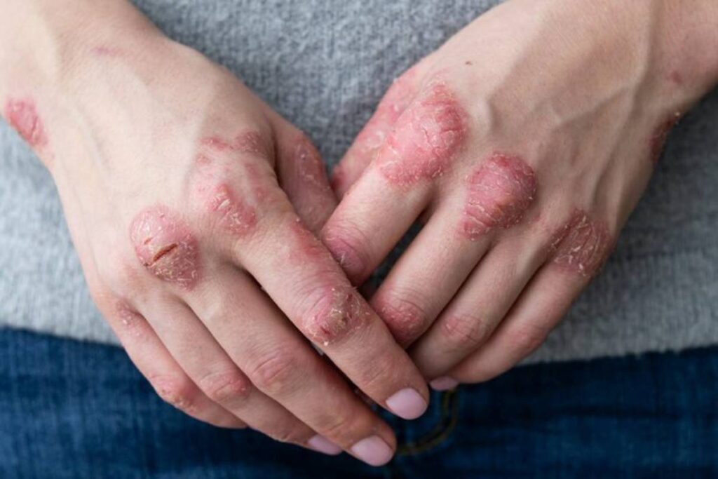 Psoriaza1