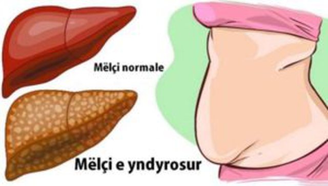 Nga kjo sëmundje vuan 1 në 5 persona pa e ditur, ja si ta kuptoni 640 0 7b5382e5f21f040e116d824c42133c00