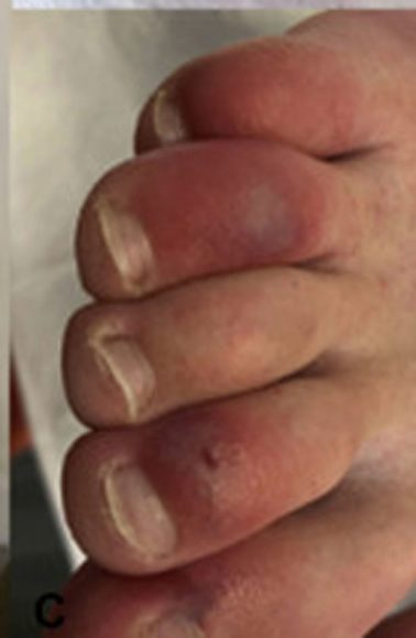 “Gishtat Covid”, simptoma e re e koronavirusit 1 koronavirus 2 378x579 1