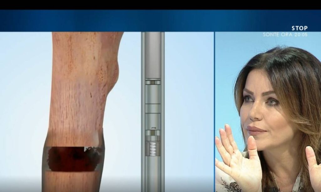 Zgjatja e gjymtyrëve, shpjegon mjekja: Po përhapet shumë, por pacienti torturohet dhe… Zagjatja e kockave 2