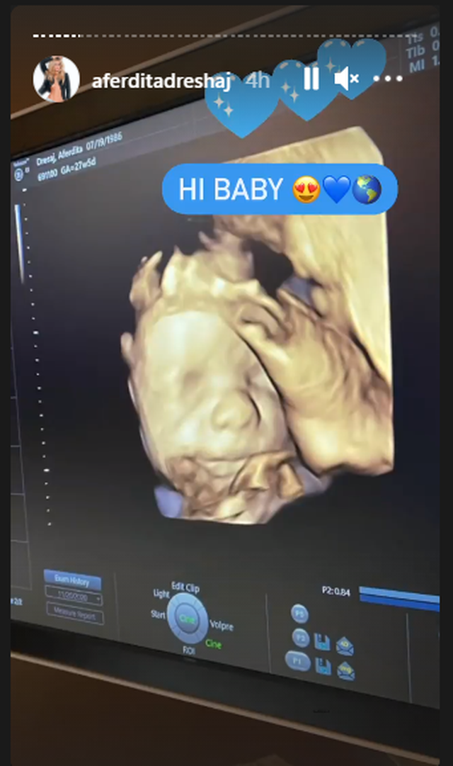 Emocionuese/ Afërdita Dreshaj tregon ekon 3D të bebushit të saj 1 640 0 5fe3a1edf386e