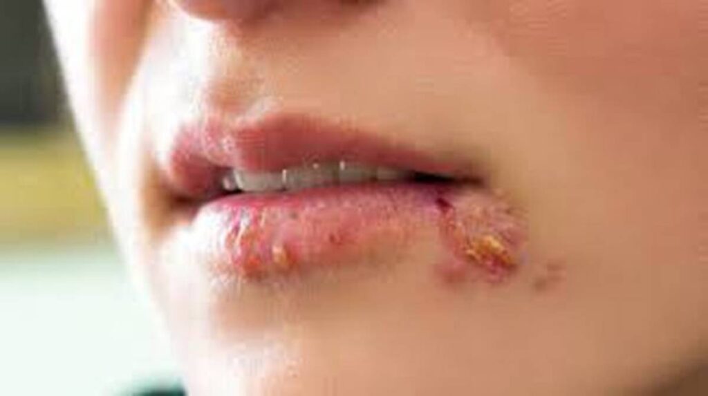 Herpes 1
