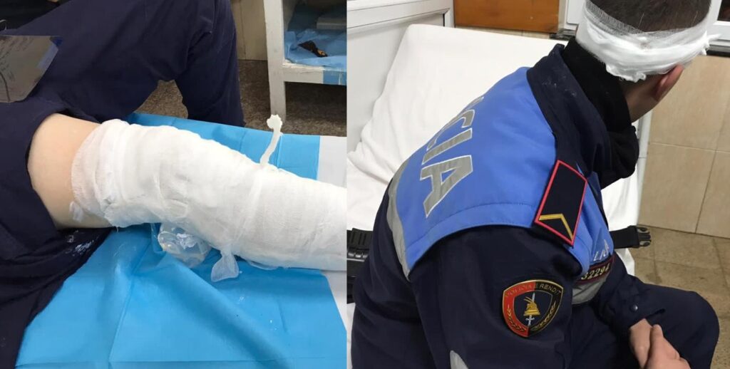 Dalin pamjet nga “Trauma”, punonjësit e policisë që u plagosën gjatë protestës policet te trauma 4 1