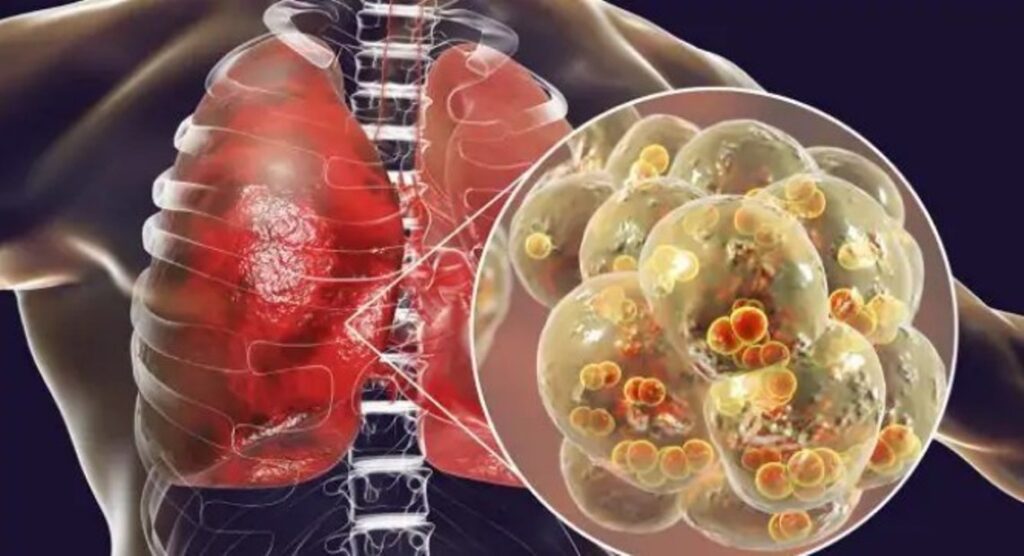 Pneumonia: Çfarë duhet të hani dhe të shmangni kur vuani nga kjo gjendje e rëndë e mushkërive mushkeri