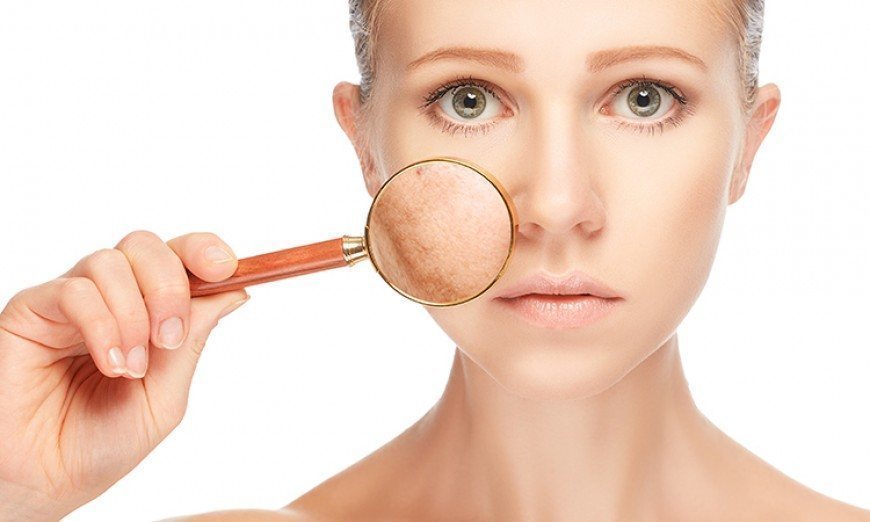 Tre arsye pse ju shfaqen njolla të errëta në lëkurë! melasma