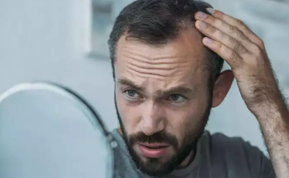 Kushtet mjekësore që mund të shkaktojnë rënie të flokëve floke