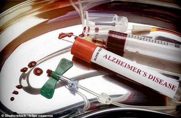 Shkencëtarët zbulojnë se si zhvillohet sëmundja Alzheimer në tru alzhaimer