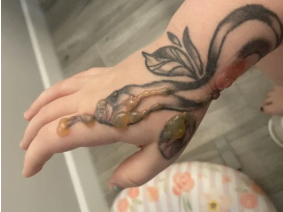 Historia alarmuese, 20-vjeçares i dalin lytha mbi tatuazh tatuazh