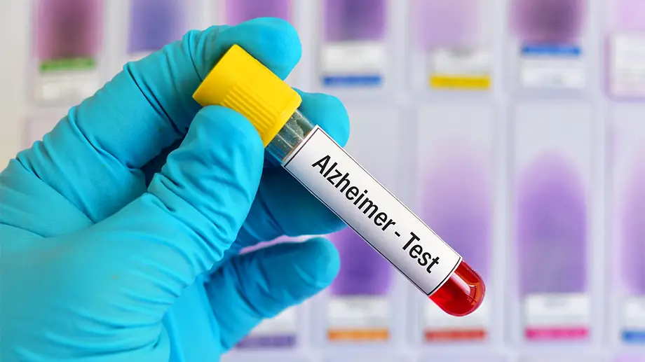 Testi i gjakut që do zbulojë Alzheimerin që në momentet e para testi alzheimer