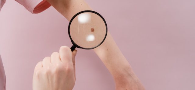 640 0 1684407747xstretch marks moles 700x324 1 171