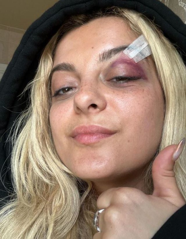 Me sy të nxirë, të ënjtur dhe me qepje, dalin fotot e Bebe Rexhës pasi u godit në koncert 1 640 0 1 9 561x720 1687191525