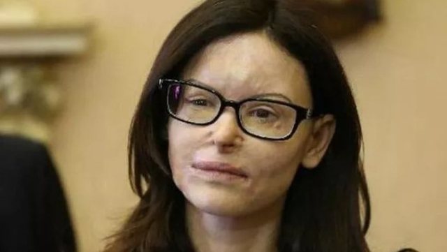 Lirohet pas 9 vitesh burg shqiptari që sulmoi me acid në fytyrë avokaten italiane: Tani nuk kam më frikë, ai është në Shqipëri Avokatja Lucia Annibali