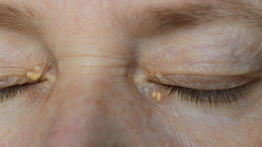 Pikat e bardha dhjamore në sy, ja çfarë tregojnë dhe si t’i trajtoni xanthelasma treatment removal gold coast