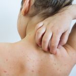 measles outbreaks 7be852a677d603d4b1c516b65e16c023a13c04e2