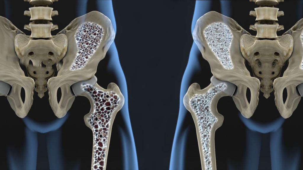 Krijohet medikamenti i parë kundër osteoporozës IMG 2509